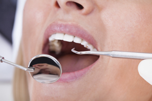 Enfermedad periodontal en Clínica Berguer