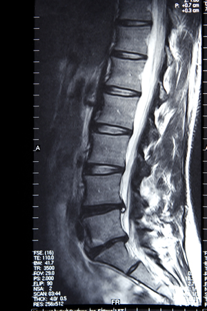 Cirugía para fractura / luxación lumbar en Hospital Nuestra Señora del Rosario