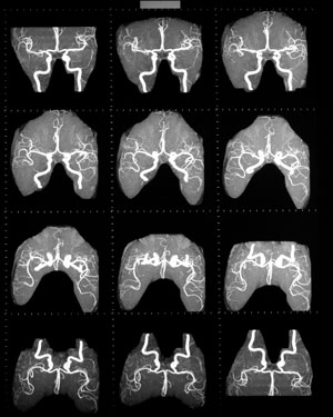 Angio-resonancia cerebral en Centro Radiología IMD Sabadell