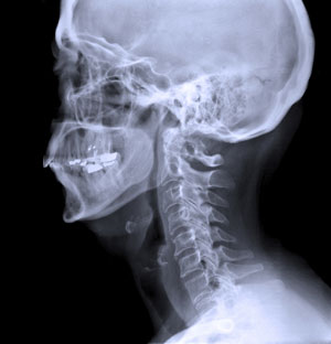 Cefalometría en Centro Radiología IMD Sabadell